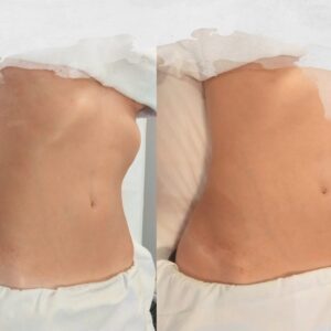 Drenagem Método Renata França